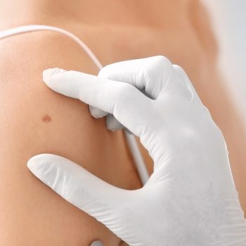 H-Birthmark-Treatments