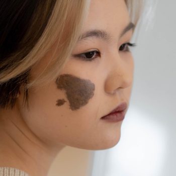 birthmark-feature
